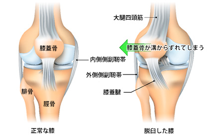 膝の構造と膝蓋骨脱臼