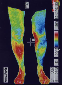 鵞足炎の原因｜左右の筋力低下や関節炎の温度分布（治療前）