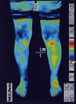 離断性骨軟骨炎の原因｜左右の筋力低下や関節炎の温度分布（治療後）