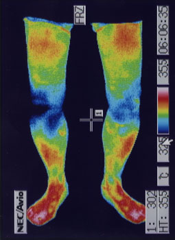 ベーカー嚢腫の原因｜左右の筋力低下や関節炎の温度分布（治療後）