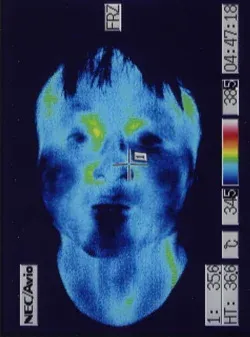 突発性難聴の原因｜ストレスで血流が低下した顔（治療前）