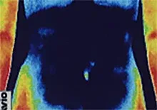 鍼治療前の間質性膀胱炎