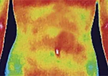 鍼治療で良くなった間質性膀胱炎
