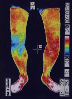 ベーカー嚢腫|治療前、膝裏の炎症が確認できる膝のサーモグラフィの様子