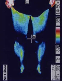 脊柱管狭窄症|治療前、腰部の炎症が確認できるサーモグラフィの様子