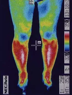 脊柱管狭窄症|治療後、腰部の炎症がおさまったことが確認できるサーモグラフィの様子