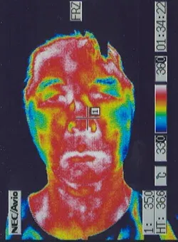 パーキンソン病｜自律神経異常｜顔の温度分布（治療後）