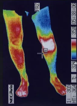 膝関節リウマチ｜膝周辺の血流状態を確認するサーモグラフィ検査