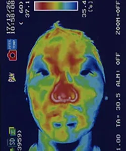 フィッシャー症候群の原因｜鍼治療で血流が改善した顔（治療後）