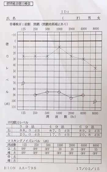 突発性難聴｜ステロイドで変化がなかった突発性難聴のオージオグラム