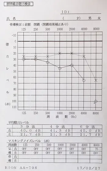 突発性難聴｜ステロイドで変化のなかった突発性難聴が鍼治療で回復したオージオグラム