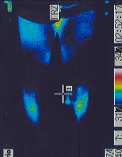 コロナ後遺症｜脚の温度分布（治療前）