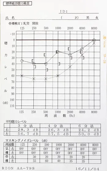 突発性難聴の原因｜ストレスで血流が低下した顔（治療前）