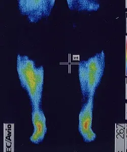 免疫力が低下した足の温度（治療前）