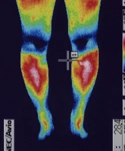 免疫力が低下した足の温度（治療後）