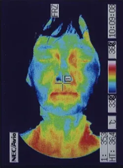 ムンプス難聴の原因｜鍼治療で血流が改善した顔（治療後）