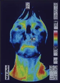 遅発性内リンパ水腫｜ストレスで血流が低下した顔（治療前）
