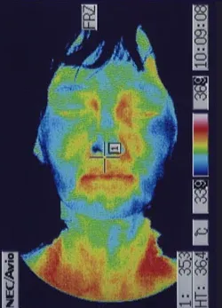 遅発性内リンパ水腫｜鍼治療で血流が改善した顔（治療後）