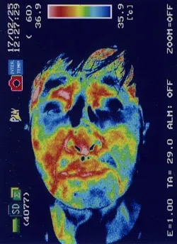 鍼治療で良くなった顔面痙攣