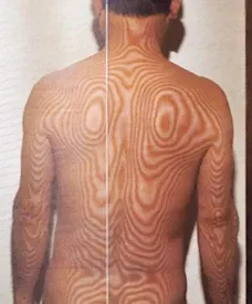 口腔心身症の原因｜頚椎の側彎（治療前）