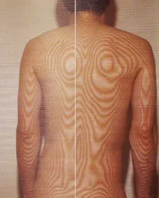 口腔心身症の原因｜頚椎の側彎（治療後）