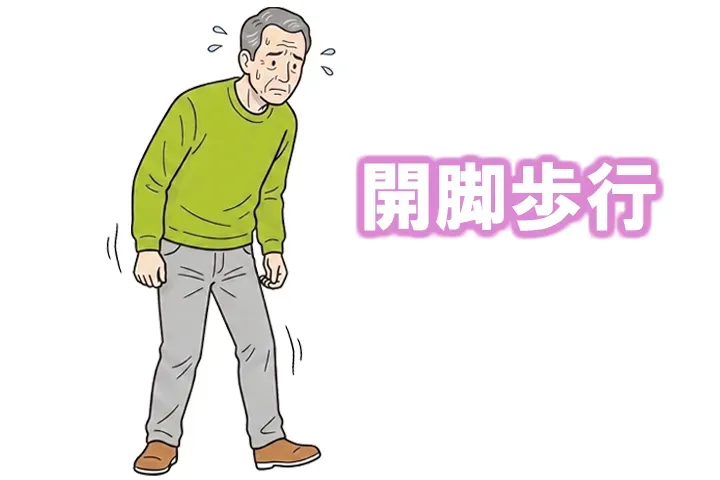 脊髄小脳変性症の患者さんで見られる失調性歩行の１つ、開脚歩行（広基性歩行）の画像