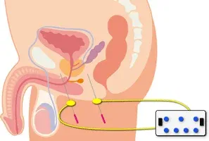 膀胱障害を改善する鍼治療