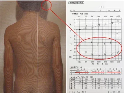 ムンプス難聴後遺症発症当時のオージオグラム検査