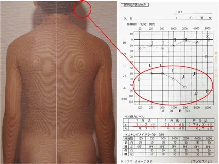 ムンプス難聴後遺症経過観察中のオージオグラム検査