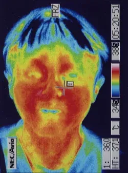 突発性難聴の原因｜鍼治療で血流が改善した顔（治療後）