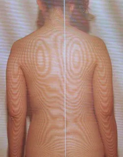 メニエール病の原因となる姿勢筋の緊張が高まり、リンパの流れが低下した背骨のモアレトポグラフィー