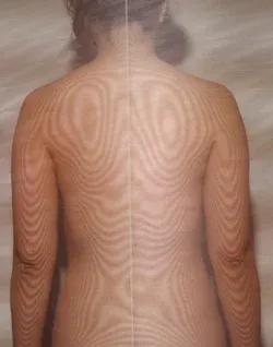 筋緊張が整ってメニエール病が起こりにくい体質になった、背骨のモアレトポグラフィー