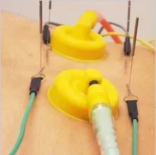 電気治療 ＋ 鍼（パルス通電）