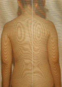 体の重心バランスの傾き（治療前）