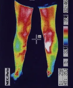 鍼治療で足の温度と血流良くなり自律神経が安定した足のサーモグラフィー