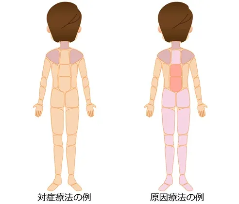 星状神経が原因の疾患|対症療法と原因療法の治療部位