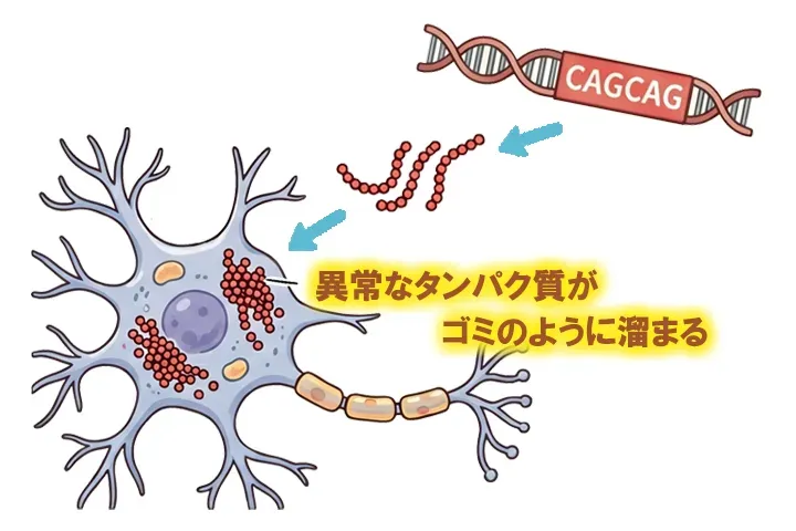 異常なタンパク質がゴミのように脳神経に溜まるポリグルタミン病の模式図