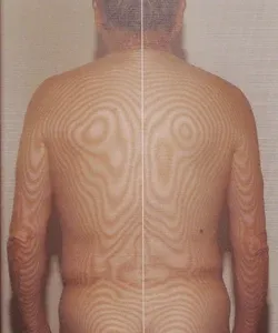 顔面神経麻痺の原因｜頚椎の側弯（治療後）