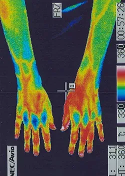 鍼治療前の手の炎症