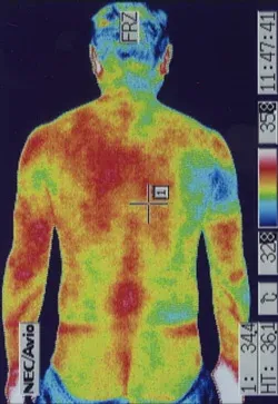 脊髄空洞症｜筋肉の代謝異常を調べます。