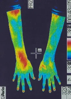 指のフォーカルジストニア