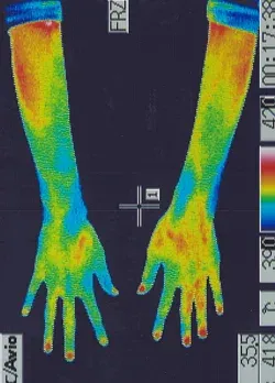 鍼治療で良くなった指のフォーカルジストニア