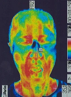 筋萎縮性側索硬化症｜口周りの温度分布（治療後）