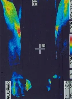 筋萎縮性側索硬化症｜手の温度分布（治療前）