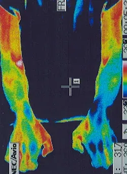 筋萎縮性側索硬化症｜手の温度分布（治療後）