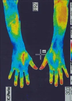 鍼治療後の手の温度