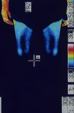 急性低音型感音難聴の原因となるストレスで温度が低下したふくらはぎのサーモグラフィー