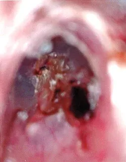 ステロイドが効かない突発性難聴の鼓膜の画像