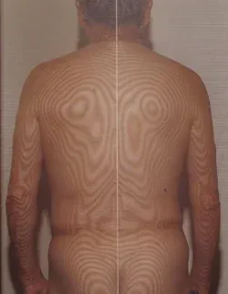 鍼治療で治った突発性難聴の背中の傾き画像