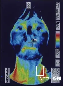 ステロイドが効かない突発性難聴の顔のサーモグラフィ画像